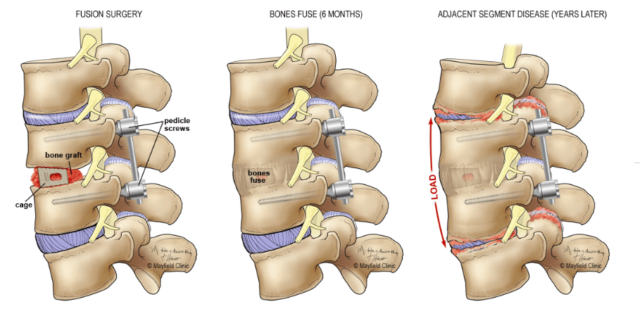 Artificial Disc Replacement Vs. Spinal Fusion Illustration showing spinal fusion surgery and adjacent segment disease over time.